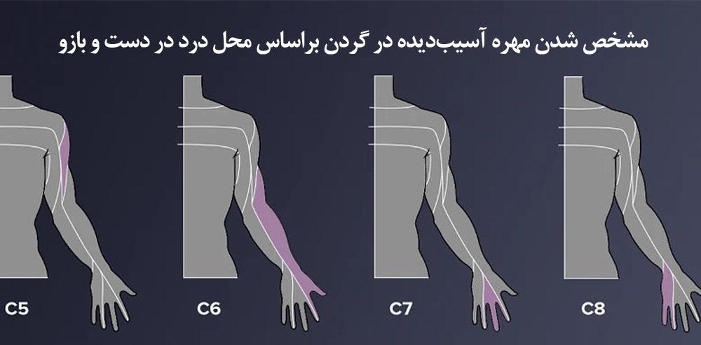 علائم دیسک گردن بر اساس محل دیسک
