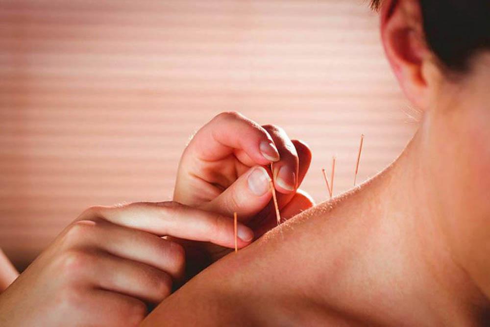 طب سوزنی یک روش غیرتهاجمی برای تسکین موقت درد گردن میباشد.