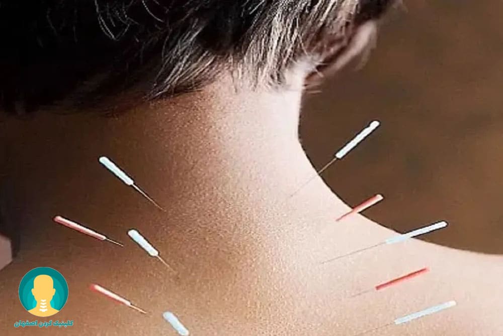 طب سوزنی برای درمان دیسک گردن
