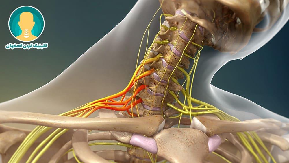 بهترین دارو برای گردن درد عصبی
