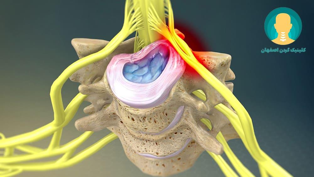 فتق دیسک مهره‌های گردن