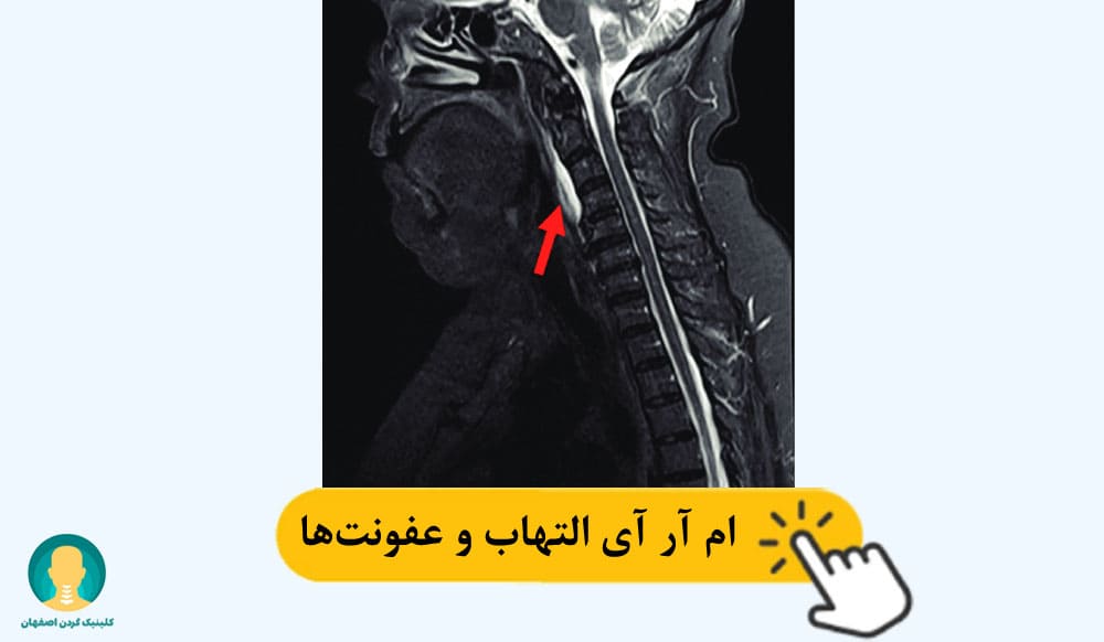 ام آر آی التهاب و عفونت‌ها 
