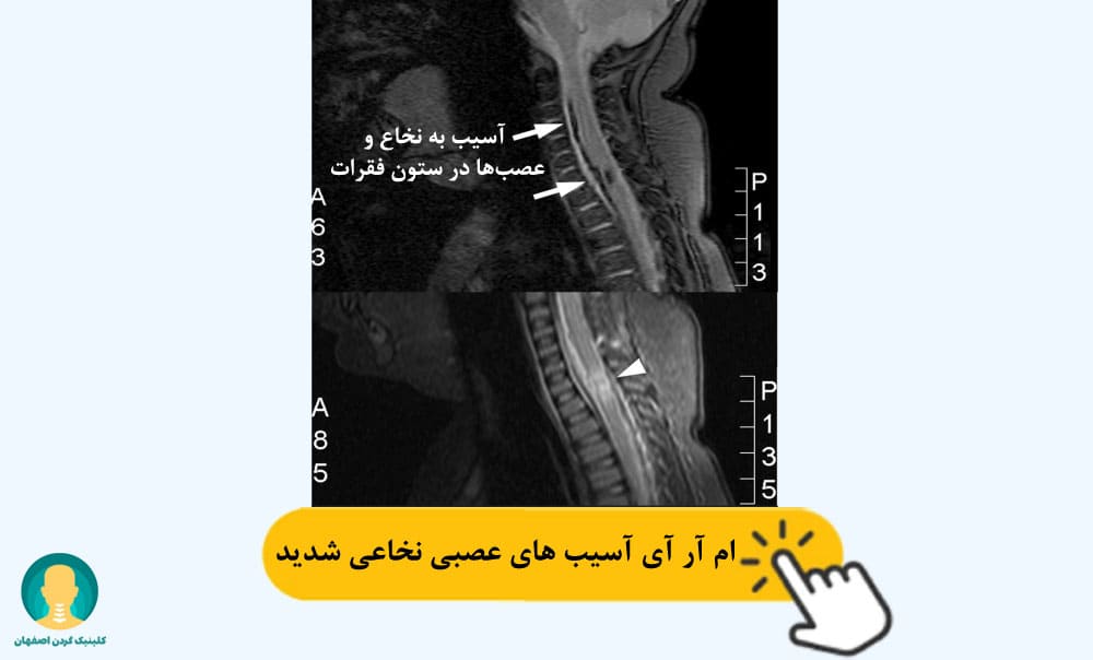 ام آر آی آسیب های عصبی نخاعی شدید