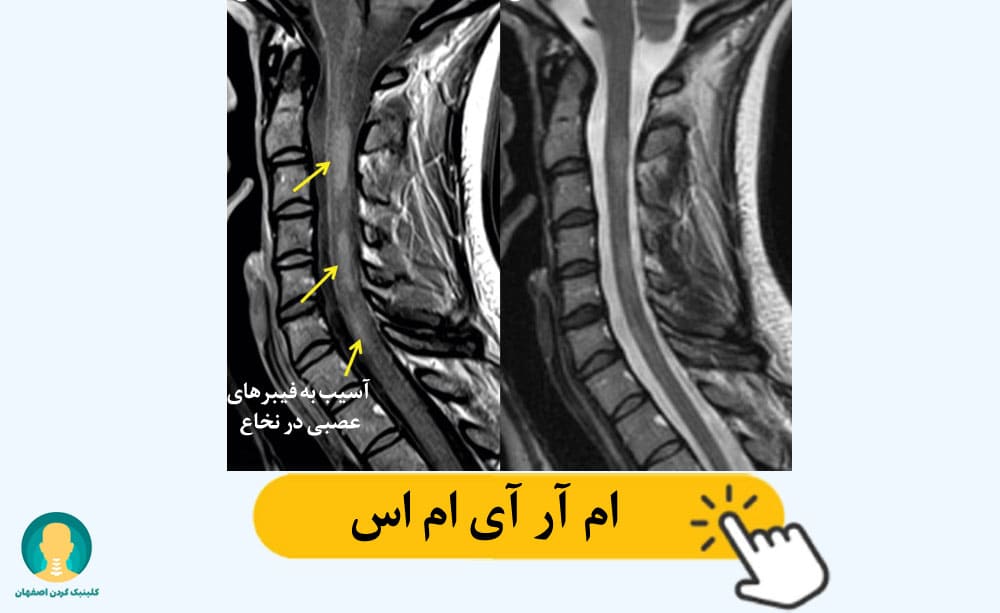 ام آر آی ام اس