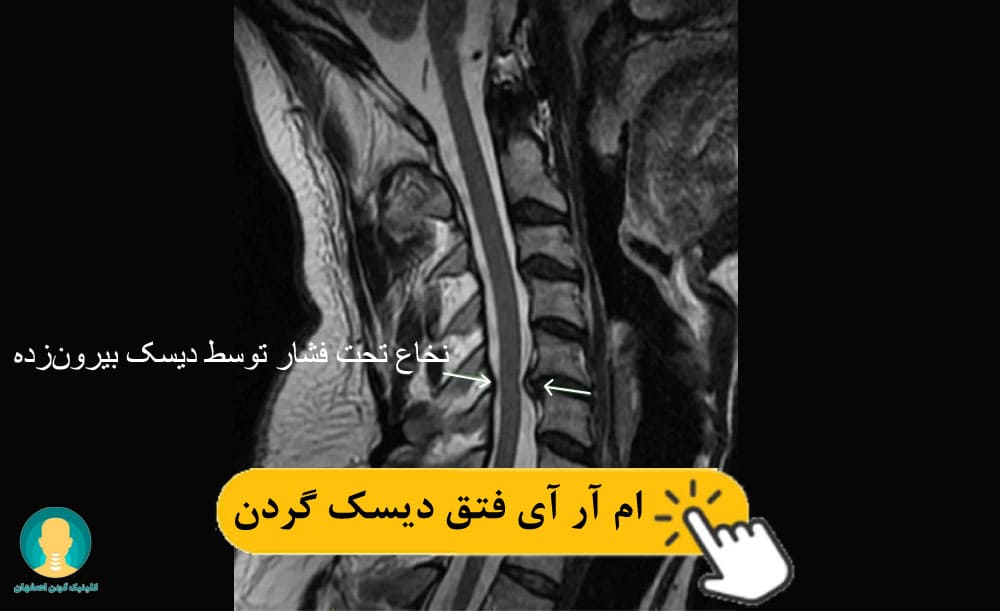 نمونه‌ای از ام آر آی گردن آسیب‌دیده 
