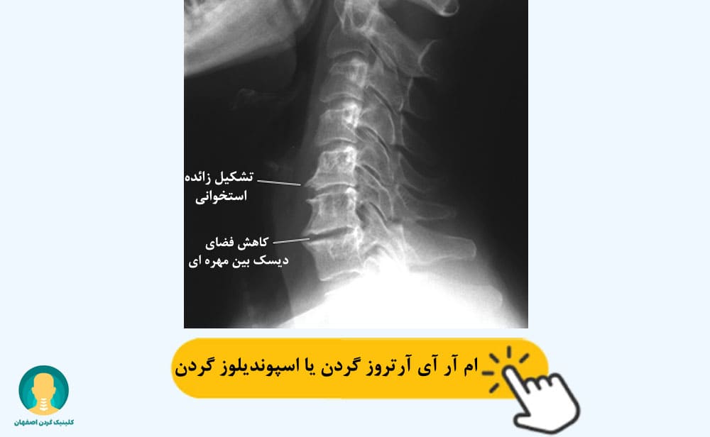 ام آر آی آرتروز گردن یا اسپوندیلوز گردن