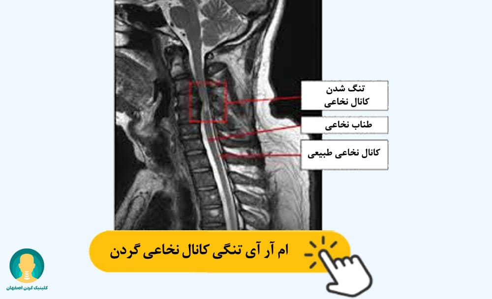 ام آر آی تنگی کانال نخاعی گردن 