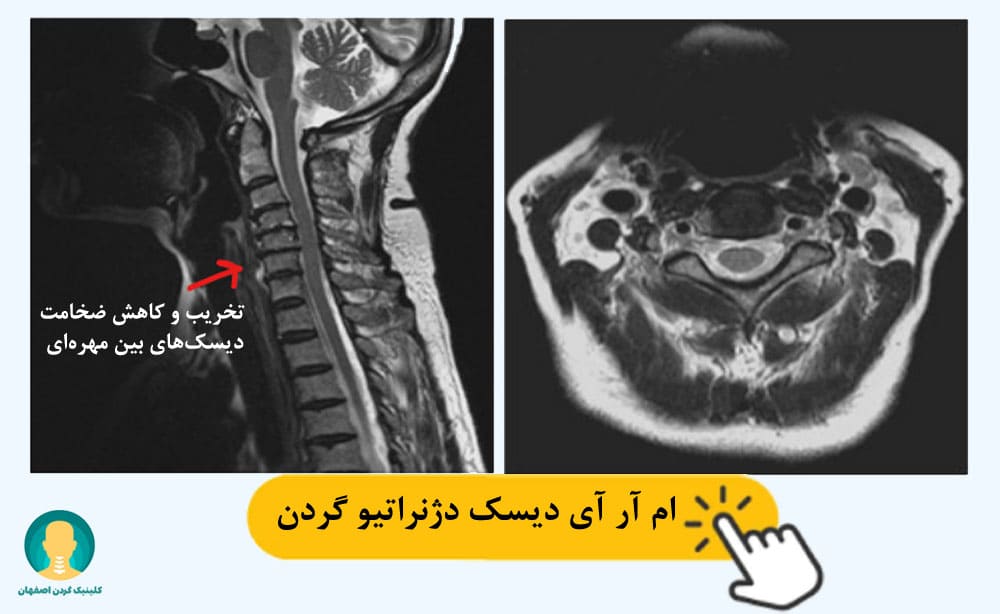 ام آر آی دیسک دژنراتیو گردن 