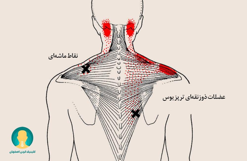 عضلات ذوزنقهای ترپزیوس و نقاط ماشهای