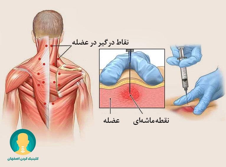 تزریق نقاط ماشهای