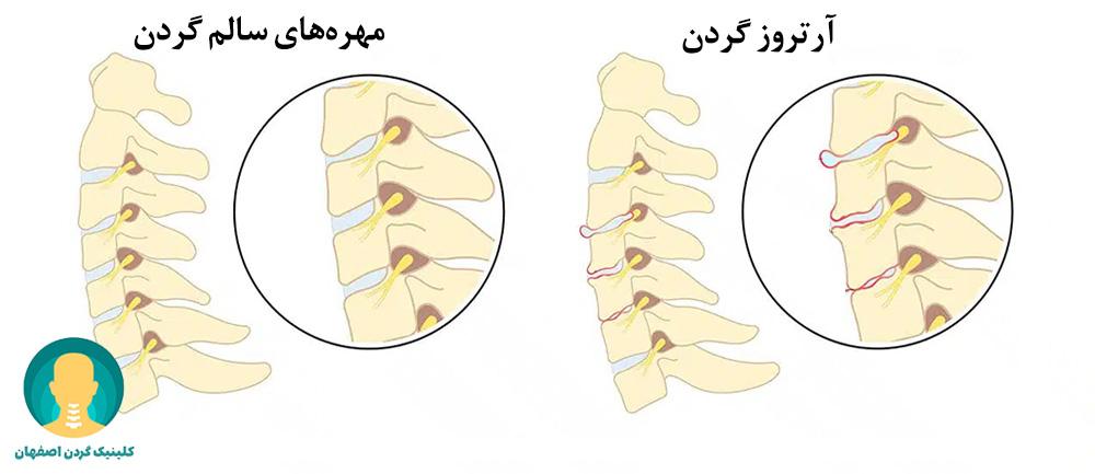 آرتروز گردن 