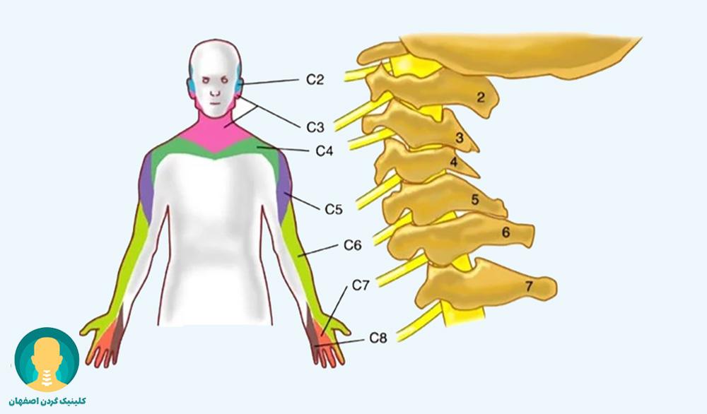 علایم فتق دیسک گردن