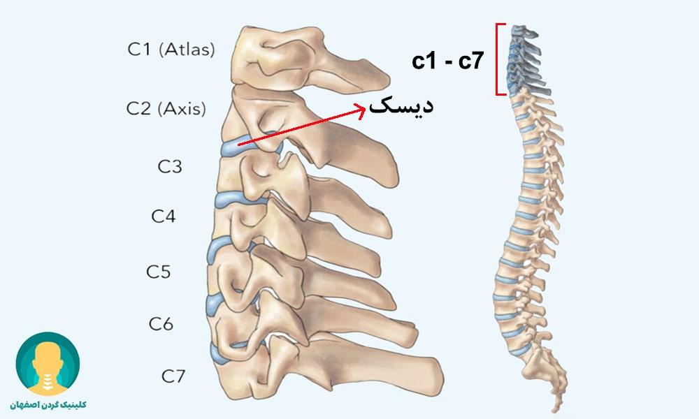 فتق دیسک گردن