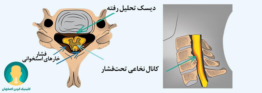 تنگی کانال نخاعی گردن