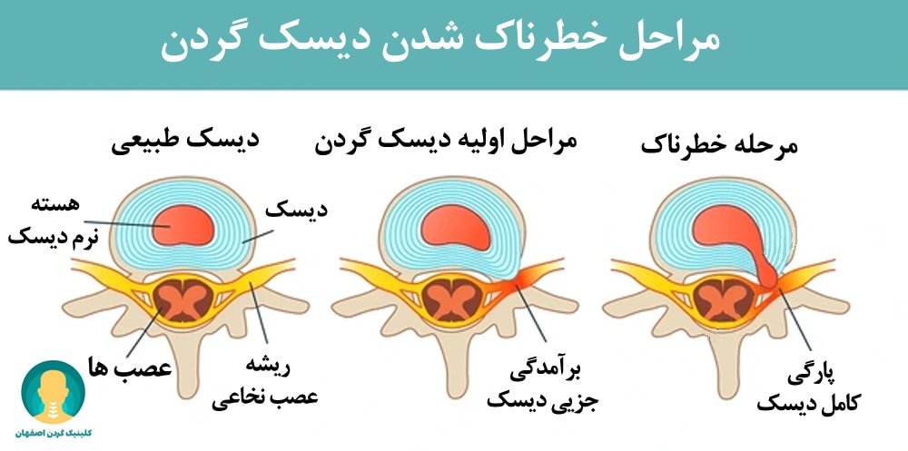 عوارض و خطرات دیسک گردن