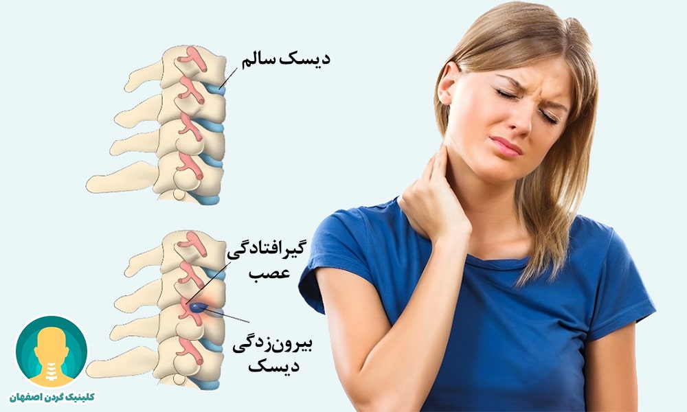 رادیکولوپاتی گردنی