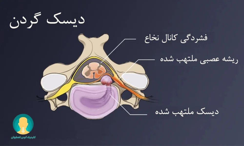 ارتباط دیسک گردن با درد دست چپ