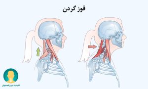 قوز گردن