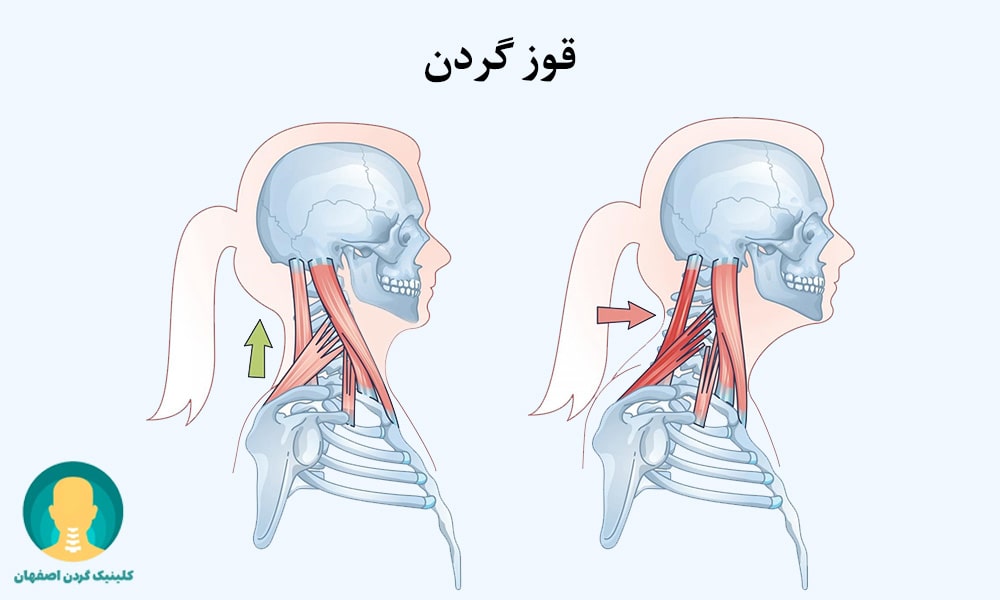 قوز گردن