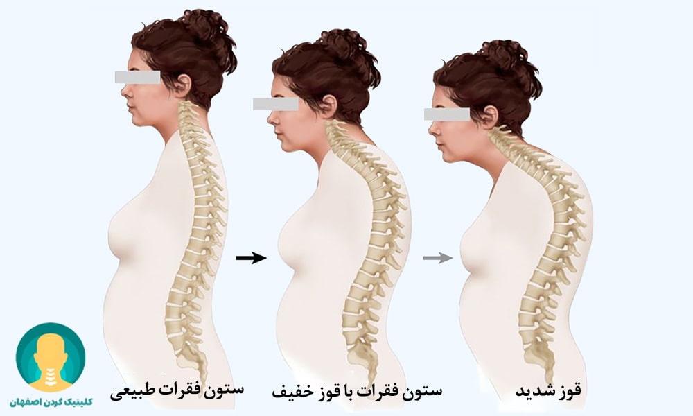 قوز گردن شدید