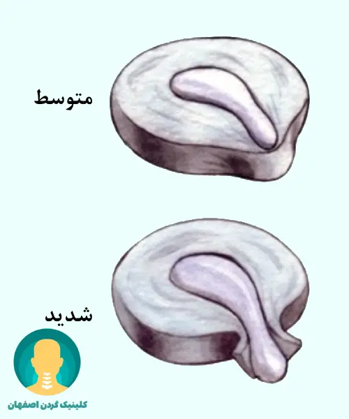 بیرونزدگی متوسط و شدید