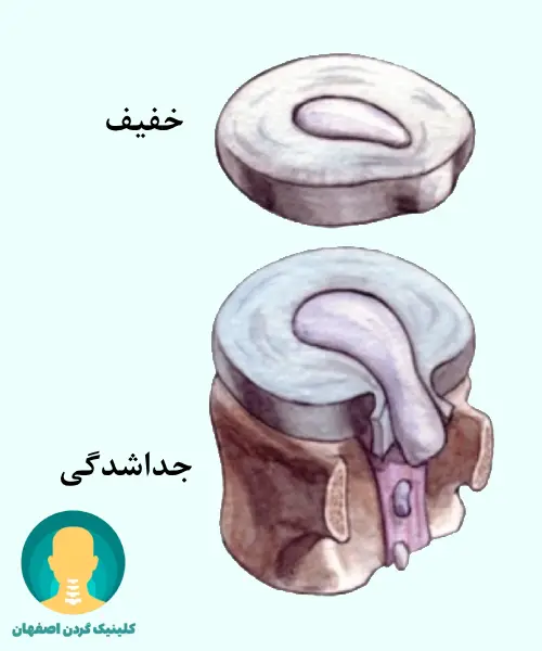 بیرونزدگی خفیف و جداشدگی