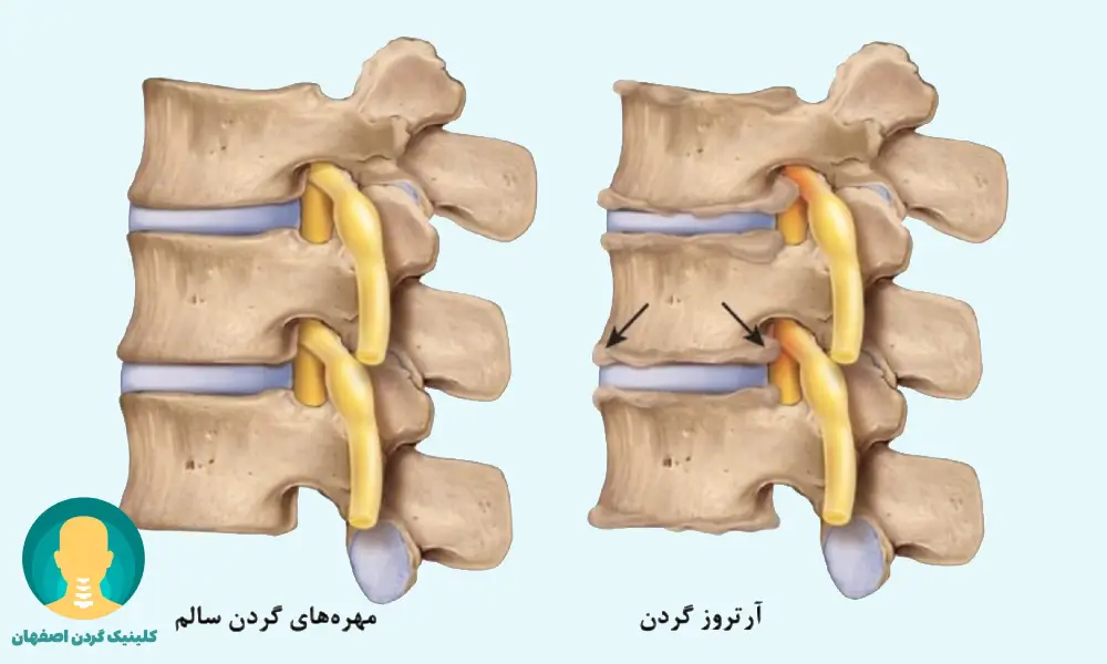آرتروز گردن